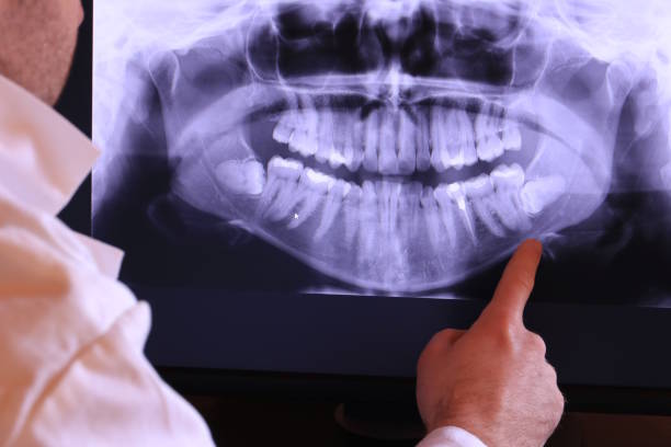 Best Emergency Wisdom Teeth Removal in Washington Terrace, UT